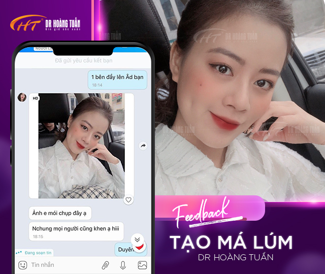 Tạo má lúm đồng tiền tự nhiên đang là xu hướng làm đẹp giúp chị em có được nụ cười duyên dáng